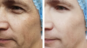 Can PRP Be Combined with Other Cosmetic Treatments Safely?