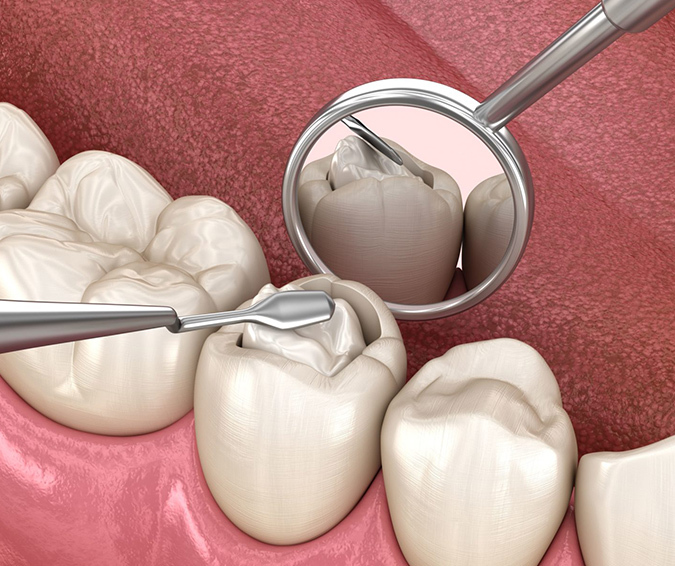 Dental Tooth Filling in Dubai