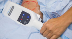 CoolSculpting Targets Fat in Hard-to-Reach Areas Effectively