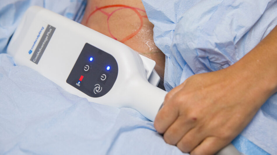 CoolSculpting Targets Fat in Hard-to-Reach Areas Effectively
