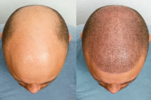 Restore Confidence With Hair Transplant in Dubai