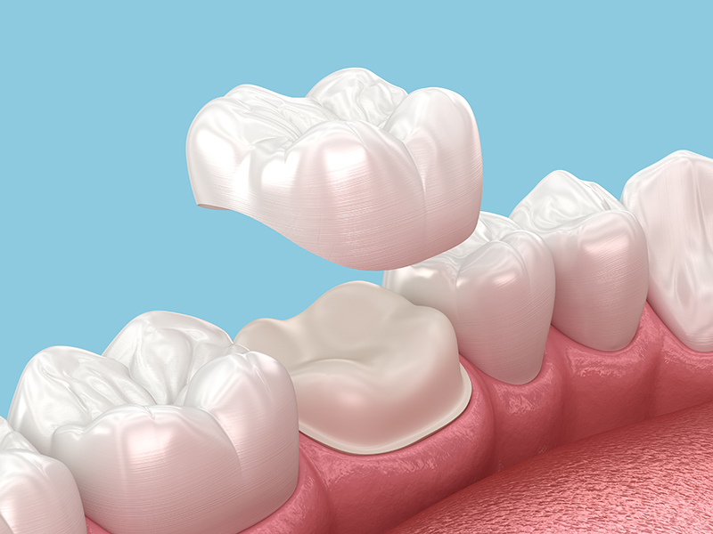 Dental Crowns and Bridges Dubai – Strengthen Your Smile