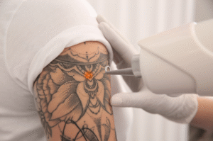 Do Laser Treatments Work on Both New and Old Tattoos?