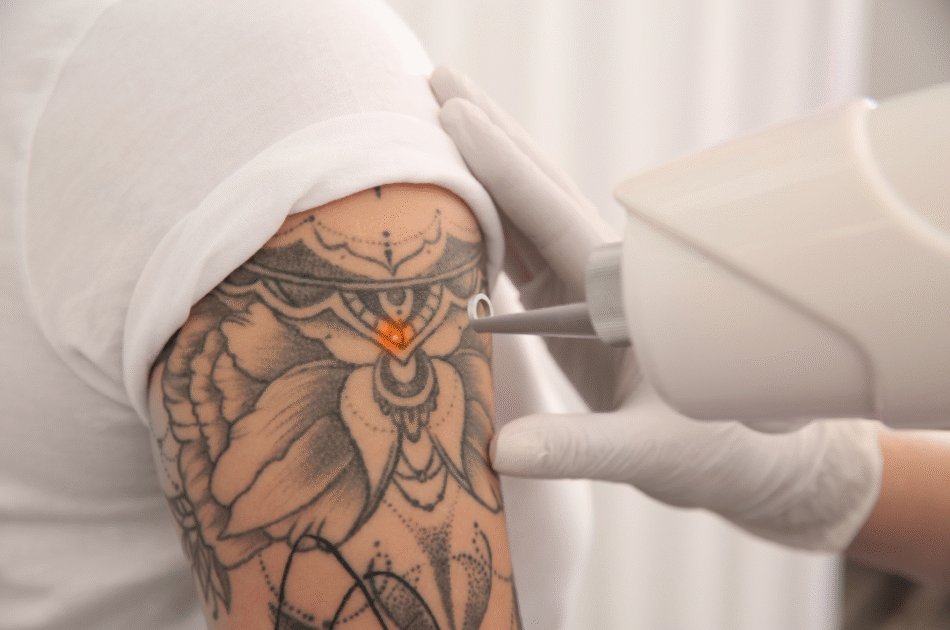 Do Laser Treatments Work on Both New and Old Tattoos?