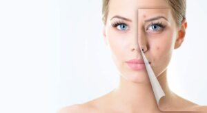 Dubai Acne Scar Treatment: Fast & Safe Options for You