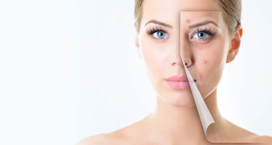 Dubai Acne Scar Treatment: Fast & Safe Options for You