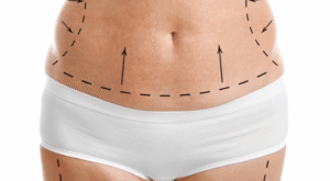 Everything You Need to Know Before a Tummy Tuck