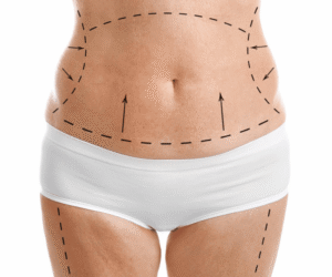 Everything You Need to Know Before a Tummy Tuck