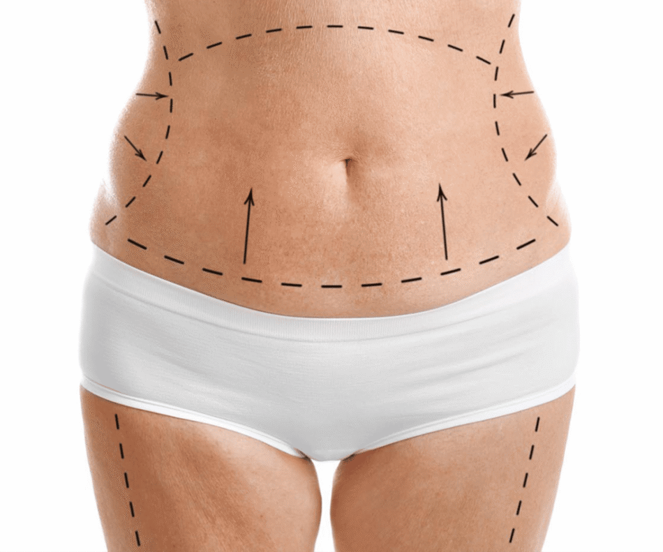 Everything You Need to Know Before a Tummy Tuck