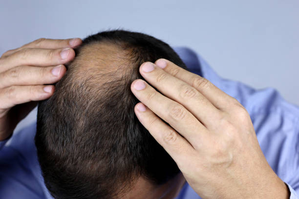 Exosomes Hair Therapy in Dubai: Why It’s Trending