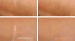 Facial Scar Removal in Dubai: Best Surgeons Revealed