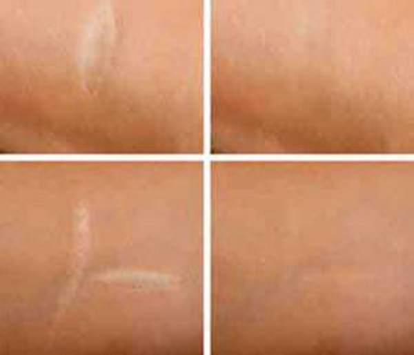 Facial Scar Removal in Dubai: Best Surgeons Revealed