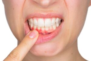 Can Receding Gums Be Reversed? Expert Advice on Treatment Options