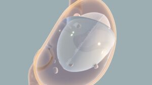 Allurion Balloon Cost in Dubai