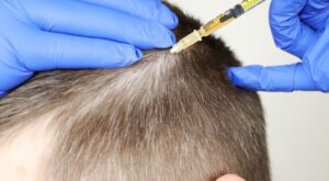 GFC Hair Treatment in Dubai for Thinning Hair: What to Expect