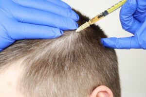 GFC Hair Treatment in Dubai for Thinning Hair: What to Expect
