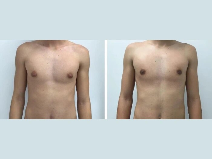 Best Gynecomastia Doctors in Dubai Expertise in Men’s Gyno Surgery