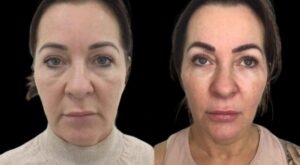 Elite Profhilo by the Best Plastic Surgeon in dubai