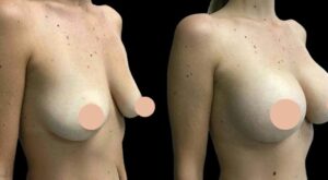 Choosing the Right Implants with the Best breast augmentation Surgeon in Dubai