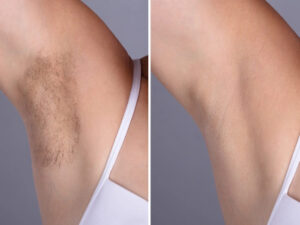 Laser hair removal Treatment in Dubai: Best Clinics and Packages