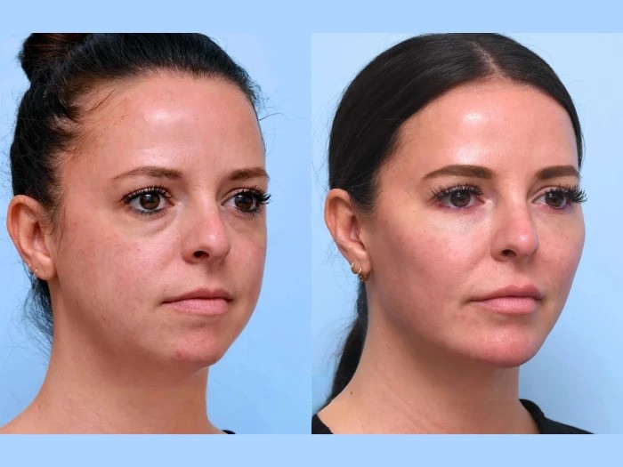 Explore How the Best Aesthetic Clinic in Dubai Delivers Instant Results with Thread Lift