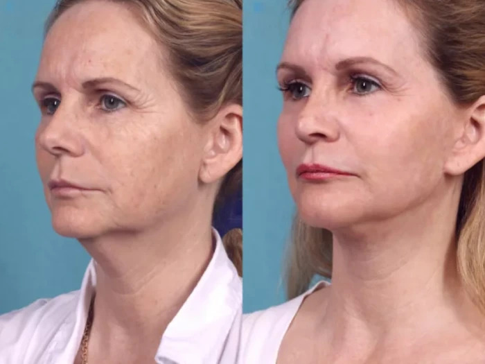 Combining Chemical Peels with Other Treatments at the Best Aesthetic Clinics in Dubai