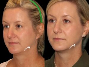 Best Plastic Surgeon in Dubai for Sculptra Pore Refining