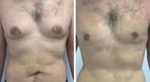What to Expect During Consultation with the Best Gynecomastia Surgeons in Dubai