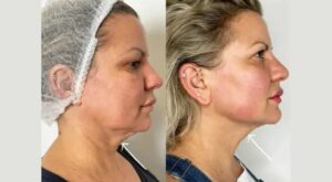 Best Plastic Surgeons in Dubai Share Insights on Endolift Cost and Value