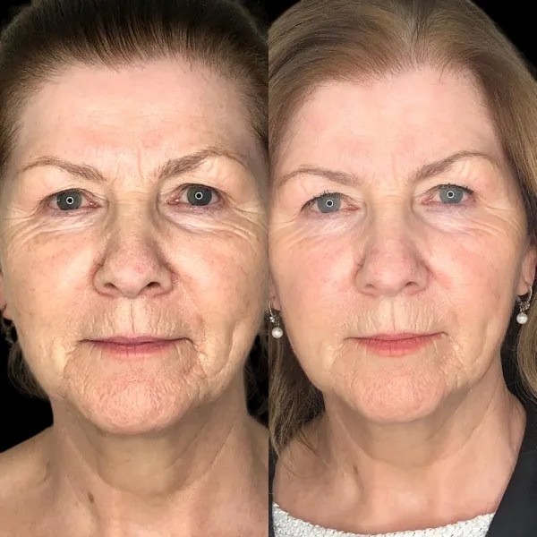 Unlocks Skin Energy through Profhilo and Best Doctors in dubai