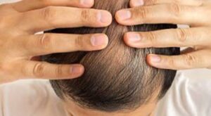 Rediscover Confidence with Sapphire FUE Hair Transplant: Why Delhi Residents are Choosing It