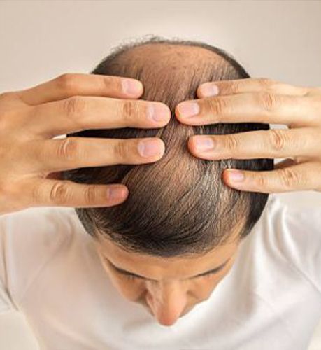 Rediscover Confidence with Sapphire FUE Hair Transplant: Why Delhi Residents are Choosing It