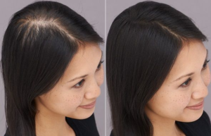 Understanding the Cost of Hair Transplant in Dubai – Complete Breakdown for 2025