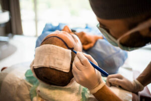 Hair Transplant in Dubai: Benefits of Latest Hair Transplant Methods