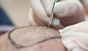 Hair Transplant in Dubai: Latest Advances & Technology