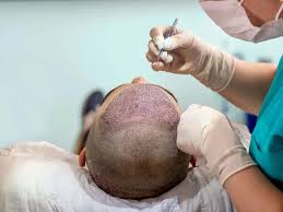 Hair Transplant in Dubai: Recovery Tips for the Best Results