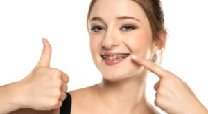 How Dental Braces Build Confidence in Young Adults ?