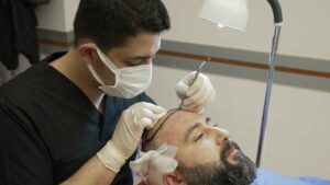 How Do Hair Transplants Help Reduce Anxiety About Hair Loss?