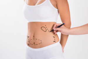 Liposuction Surgery in Dubai That Empowers and Elevates