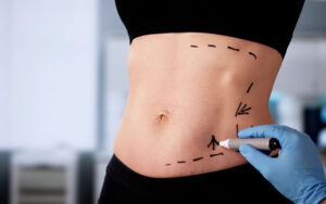 How Long Does Swelling Last After Liposuction?