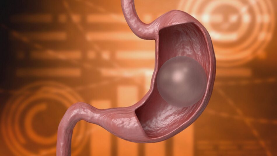 How do I choose the right type of gastric balloon in Dubai?