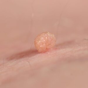 How do dermatologists choose the best method for skin tag treatment in Dubai?