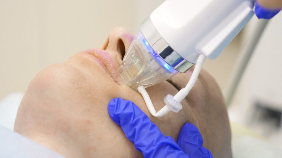 How to Maximize Fractional RF Microneedling Benefits