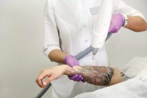 Is Laser Tattoo Removal the Best Way to Erase Ink?