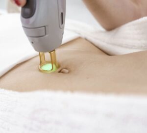 Preparing for Laser Hair Removal in Dubai: What You Need to Know