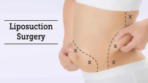 Liposuction in Dubai: Transform Your Body Safely and Effectively