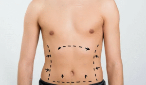 Liposuction Surgery in Dubai: Expert Body Contouring Solutions