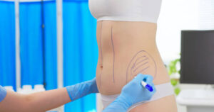 Liposuction in Dubai: How to Prepare for Surgery