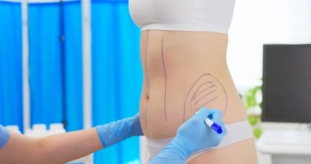 Liposuction in Dubai: How to Prepare for Surgery
