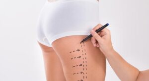 Surgery Method Explained by Best Liposuction Surgeons in Dubai